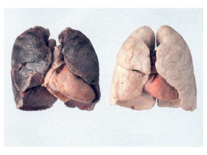 Confronto polmoni 